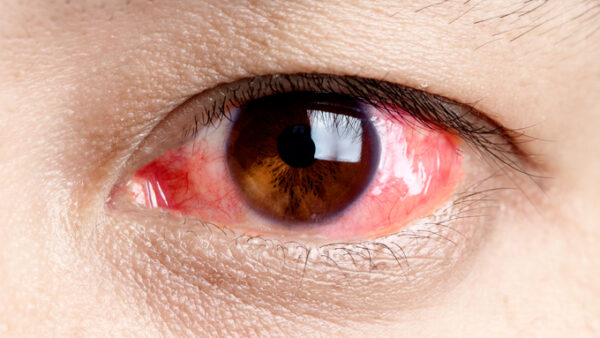 結膜炎について